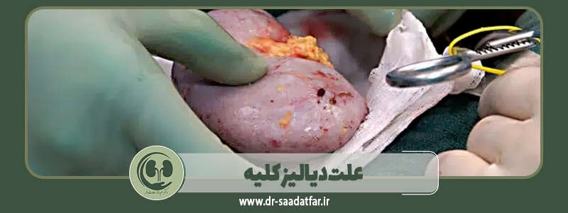 علت دیالیز کلیه چیست و چه بیمارانی به آن نیاز پیدا میکنند؟