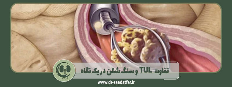تفاوت TUL و سنگ شکن در یک نگاه