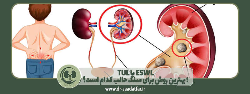 TUL یا ESWL؛ بهترین روش برای سنگ حالب کدام است؟