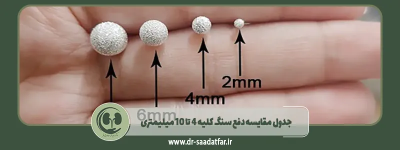 جدول مقایسه دفع سنگ کلیه 4 تا 10 میلیمتری