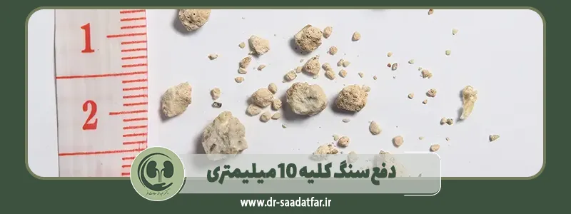 دفع سنگ کلیه 10 میلیمتری