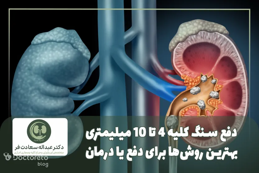 دفع سنگ کلیه 4 تا 10 میلیمتری؛ بهترین روش_ها برای دفع یا درمان