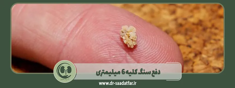 دفع سنگ کلیه 6 میلیمتری