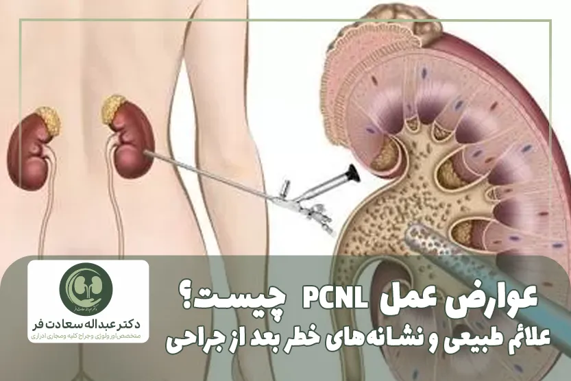 عوارض عمل PCNL چیست؟ علائم طبیعی و نشانههای خطر بعد از جراحی