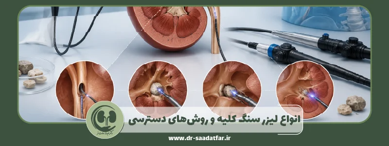 انواع لیزر سنگ کلیه و روش_های دسترسی