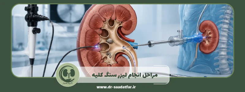 مراحل انجام سنگ کلیه
