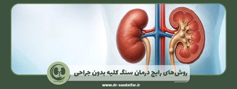 روش_های رایج درمان سنگ کلیه بدون جراحی